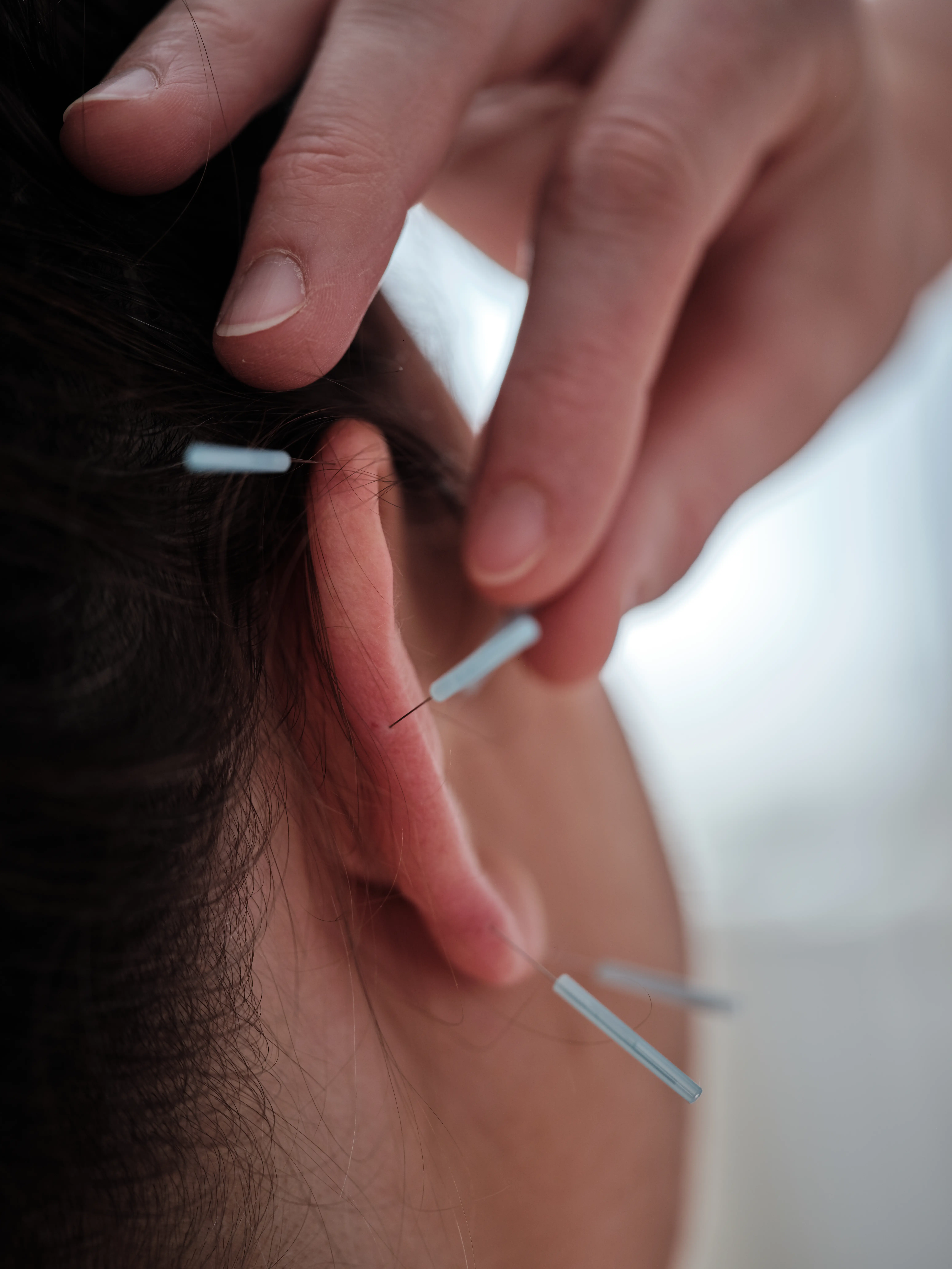 Bild, das Ohrakupunktur darstellt